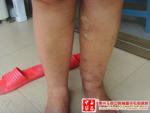 下肢深静血栓疾病的鉴别