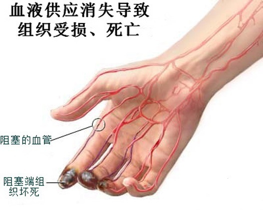 脉管炎吃什么好吗？